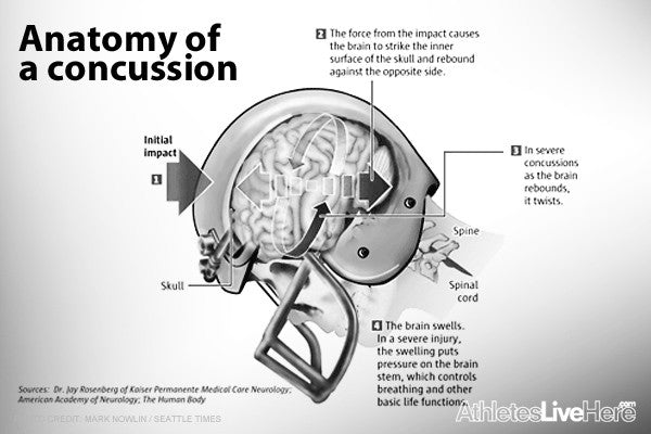 Should You Exercise After A Concussion?